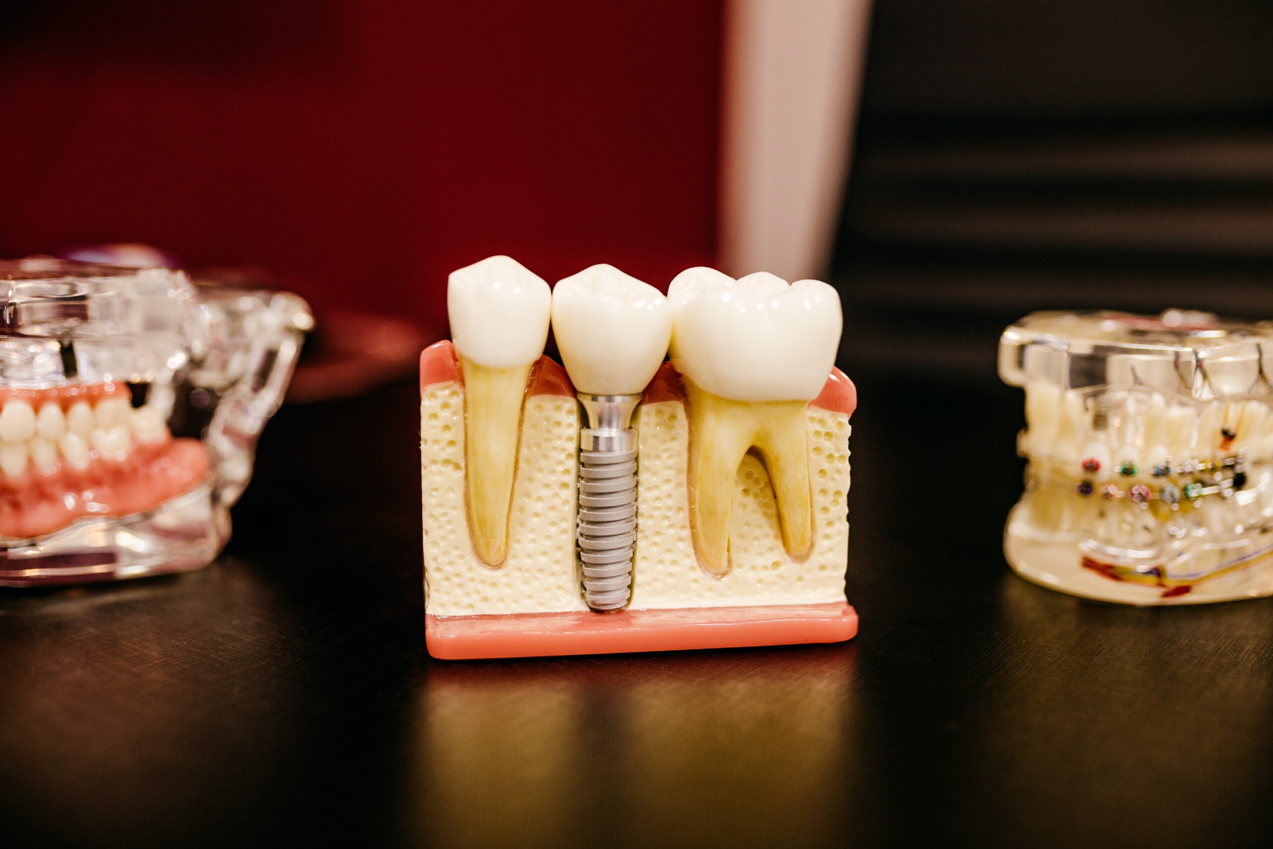 4 beneficii aduse de catre un implant dentar. Iata de ce merita sa apelezi la un asemenea tratament!