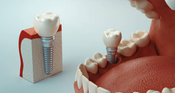 Implanturi dentare de înaltă clasă la clinica Dental Elite: Soluția pentru un zâmbet durabil
