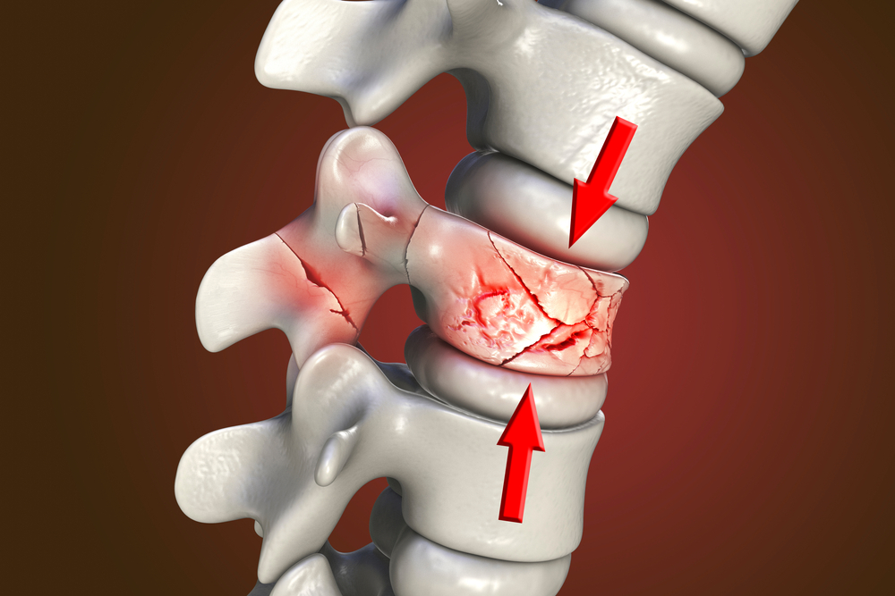 Fracturile vertebrale: cauze și opțiuni de tratament